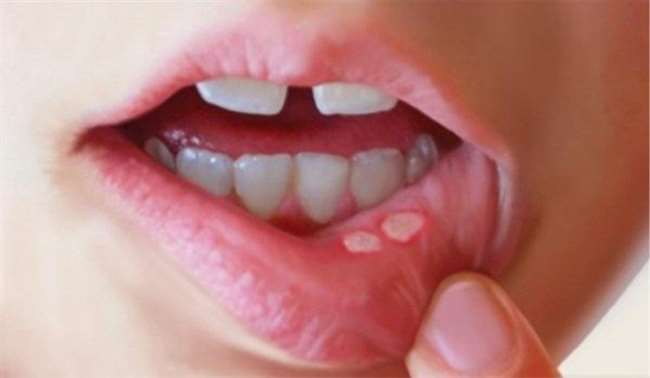 मुंह के छालों और गले के संक्रमण से परेशान है ?तो इन चीज़ें का सेवन ज़रूर करें