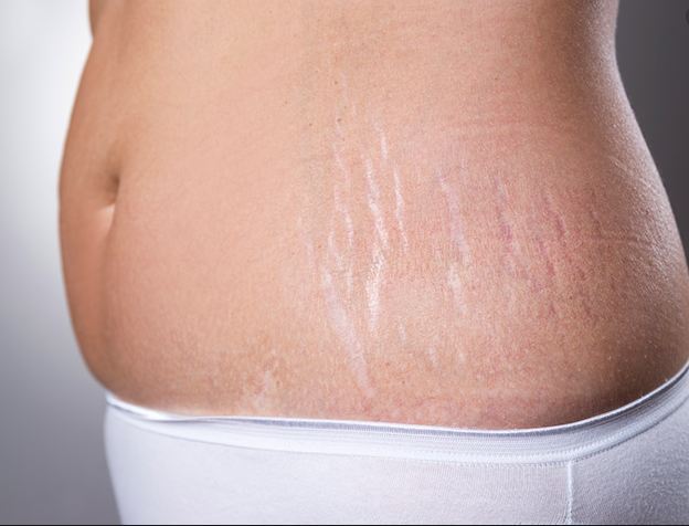 After stretch mark delivery, the marks on the stomach of women will disappear due to these three things
