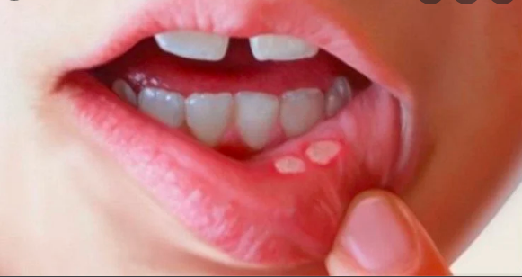 Causes and home remedies for ulcers in mouth, tongue, throat and lips