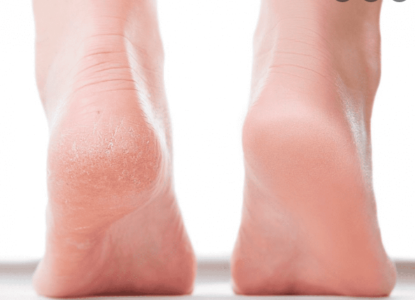 Make cracked heels soft, soft and attractive with this home remedy