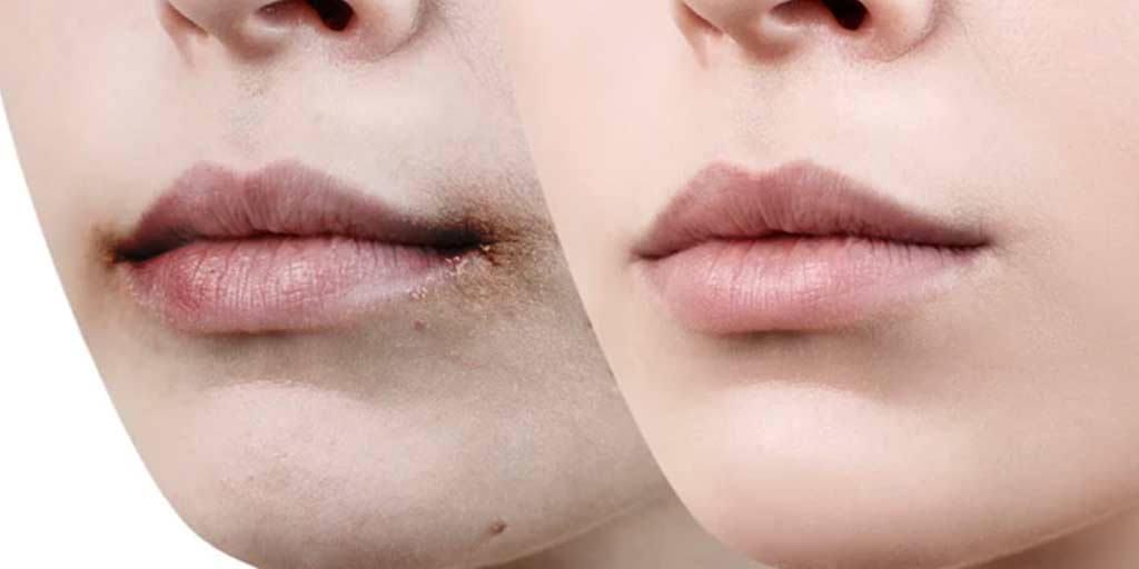 The area around the lips is getting dark, so get rid of these tips forever