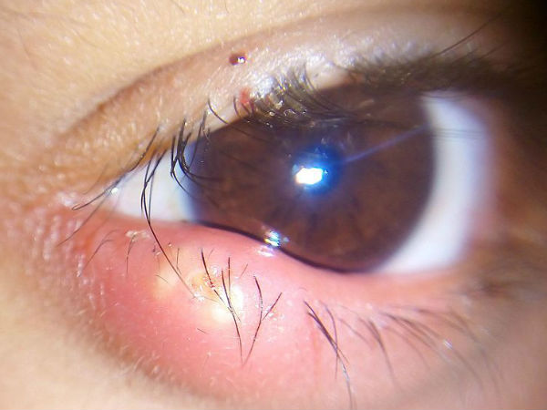 If there is a painful cavity in the eyes, then get rid of these remedies, definitely know