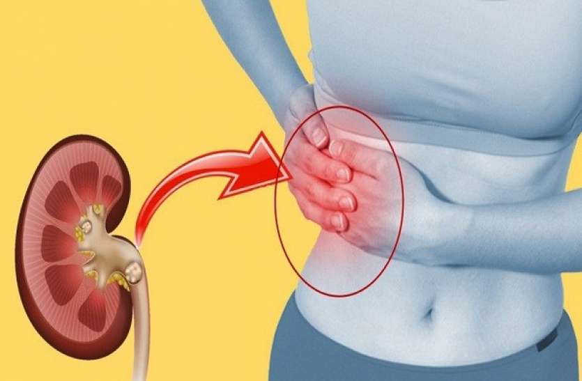 Due to kidney stones, avoid these things if you have kidney stones