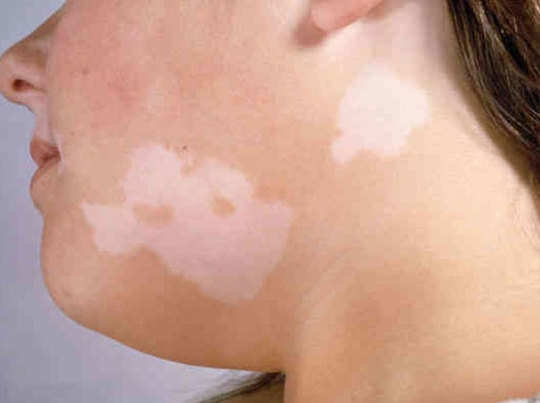 Use these things to have white spots on the body, definitely see