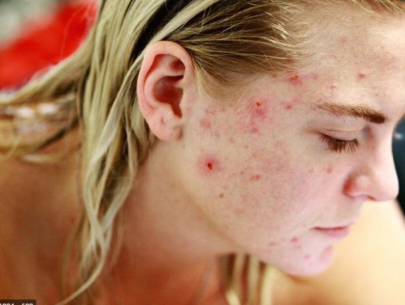 acne-treatment-can-be-found-in-natural-acne-medicine मुँहासे का उपचार
