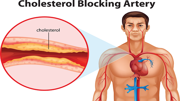 Follow this home remedy to reduce cholesterol, it will be beneficial