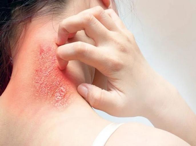 From old to old herpes-itching, fix it immediately, follow this ayurvedic recipe