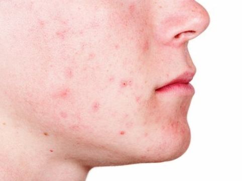 acne-treatment-found-in-natural-acne-products मुँहासे का उपचार