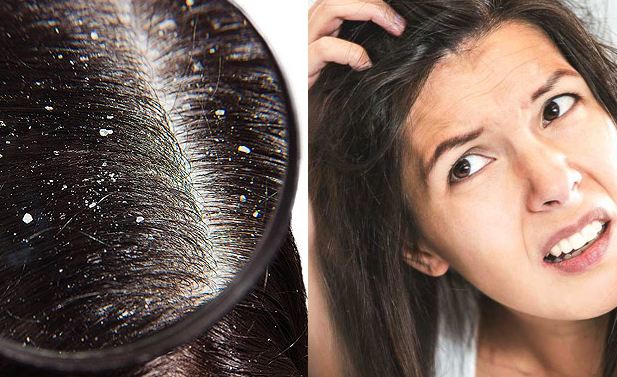 what-are-the-main-causes-of-dandruff-in-hair रूसी होने के प्रमुख कारण क्या है