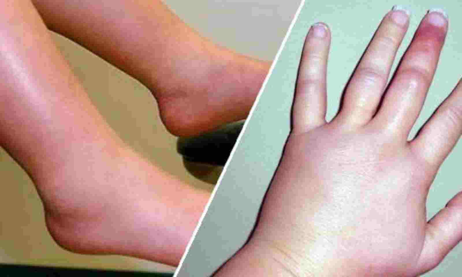 Home remedies to remove swelling on the body in winter seas