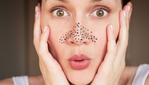 Know the causes, symptoms and treatment of blackheads here