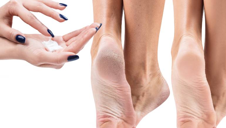 Are you also troubled by cracked heels? Now get rid of cracked heels in one night