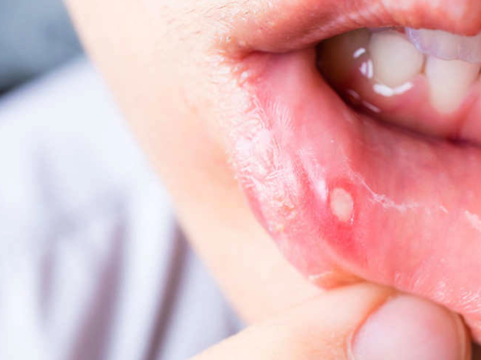 Mouth ulcers disappear in one day home remedies for mouth ulcers